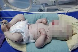 Bé sơ sinh chằng chịt vết nứt sâu khắp cơ thể do mắc bệnh hiếm gặp