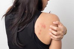 Những vết mẩn đỏ cảnh báo căn bệnh ung thư phổ biến