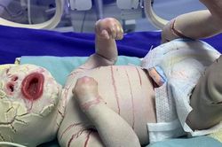 Xót xa hình ảnh bé sinh non da bị lớp sừng bao phủ, nứt toác