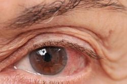 Bệnh glaucoma - cườm nước