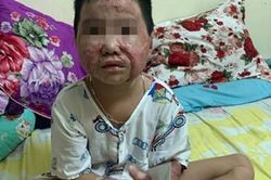 Câu chuyện cậu bé bị dì tẩm xăng đốt