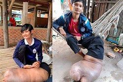 Bị muỗi đốt, chàng trai phải sống với bên chân dị dạng hơn 2 thập kỷ