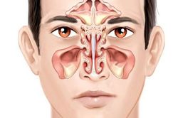 Những dấu hiệu nhận biết viêm xoang cấp tính điển hình