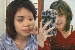 Bị hôn phu tạt axit, nhan sắc cô gái thay đổi ngoạn mục