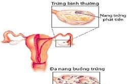 Bài thuốc trị bệnh buồng trứng đa nang