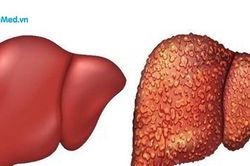 Các bệnh tự miễn thường gặp