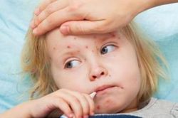 Những sai lầm khi chăm sóc bệnh nhân sởi