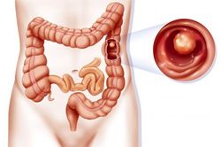 Bí kíp giúp người viêm đại tràng tự do ăn uống không lo tái lại