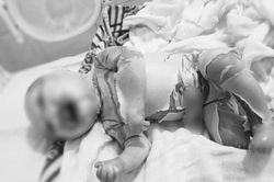 BV Nhi Trung ương hỗ trợ tối đa về chuyên môn, thuốc điều trị cho bệnh nhi da vảy cá tại Hà Giang