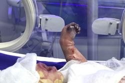 Gửi phân tích mẫu gen của bé sơ sinh mắc bệnh 'da vảy cá' cực hiếm gặp ở Hà Giang