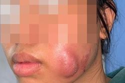Tạo má lúm đồng tiền làm duyên, thiếu nữ 16 tuổi bị sưng vù mặt