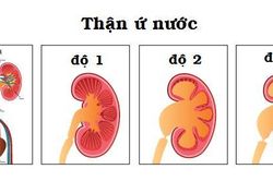 Cách phát hiện sớm thận ứ nước