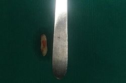 Răng mọc ngược, chọc thủng hốc mũi của một nam thanh niên
