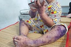 Báo động đỏ về bệnh tay - chân - miệng của trẻ