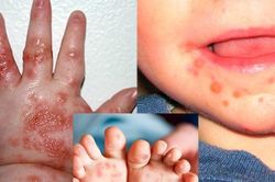 Có cần dùng thuốc bôi trong bệnh tay chân miệng?