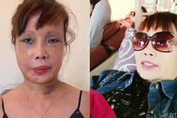 'Cô dâu 62 tuổi' gây bất ngờ với diện mạo mới sau thời gian vật lý trị liệu vì biến chứng phẫu thuật