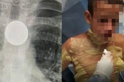Cô bé 8 tuổi nhập viện khẩn cấp, suýt mất mạng vì bắt chước trò 'ảo thuật' trên TikTok