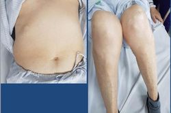 Tình trạng lạm dụng corticoid có xu hướng tăng lên
