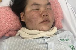 Tình cảnh khốn cùng của gia đình hai con nguy kịch khi mắc bệnh lupus ban đỏ