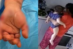 Kinh hoàng cảnh người giúp việc ấn tay em bé 14 tháng tuổi vào nước đang sôi