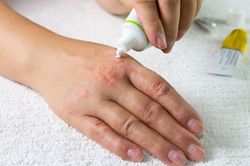 Điều trị nấm da bằng thuốc kháng nấm tại chỗ đem lại hiệu quả ra sao?