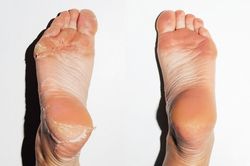 8 cách chữa nứt nẻ gót chân tại nhà