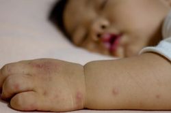 Kinh nghiệm chăm sóc trẻ mắc bệnh tay chân miệng, tránh biến chứng, nhanh hồi phục