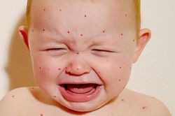 Vaccine sởi đơn và vaccine kết hợp sởi - quai bị - rubella: Nên chọn tiêm loại vaccine nào mới tốt?