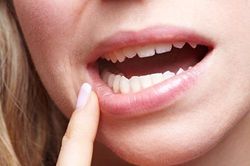 Răng khôn mọc lệch, ngầm: Nhổ hay không nhổ?