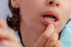 Bị nhiệt miệng nên làm gì, kiêng gì?