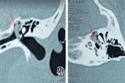 Bé gái 13 tuổi bị điếc do khối cholesteatoma ăn mòn tai