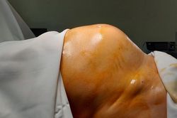 Người phụ nữ Hà Nội bụng to như sắp đẻ tưởng ăn khỏe hóa ra ung thư