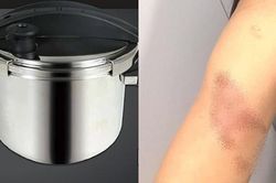 Đang nấu ăn thì nồi áp suất phát nổ: Một người mẹ bị bỏng nặng, em bé 2 tuổi thoát nạn