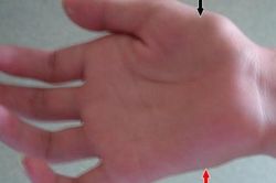 Bàn tay của cậu bé 16 tuổi trở nên 'mỏng' một cách khó hiểu và luôn run rẩy, bác sĩ khuyến cáo một hành động nhiều người vẫn hay làm có thể dẫn đến bệnh này