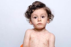 Dựa vào dấu hiệu bệnh sởi để phân biệt với sốt phát ban, Rubella và thủy đậu