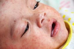 Biến chứng não do sởi gây ra những hệ lụy khôn lường cho sức khỏe