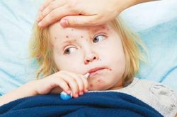 6 điều cần lưu ý khi chăm sóc người bị bệnh sởi tại nhà