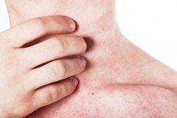 Các dấu hiệu của bệnh sởi theo từng giai đoạn như thế nào?