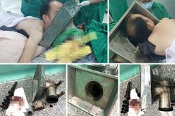 Rửa máy xay thịt, nam thanh niên bị cuốn nguyên cánh tay vào cối