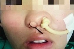 Quyết định táo bạo cứu thai phụ ung thư vòm họng 'mẹ tròn, con vuông'