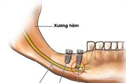 Biến chứng của trồng răng implant sai cách