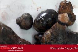 Lấy thành công sỏi san hô như củ gừng cho bệnh nhân sỏi thận