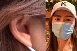 Vào viện thẩm mỹ để sửa mũi, cô gái sốc khi phát hiện ra đã bị cắt mất một phần tai