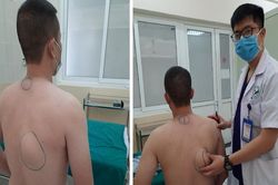 Phát hiện 2 khối u mỡ trên lưng người đàn ông nghiện rượu