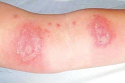 Cẩn thận với viêm da tiếp xúc do côn trùng mùa mưa bão