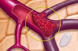 Huyết khối tĩnh mạch não: Bệnh nguy hiểm, cần phát hiện sớm