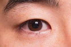 Dùng thuốc gì khi bị lẹo mắt?
