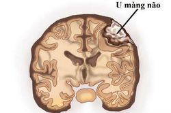 Những triệu chứng cảnh báo u màng não