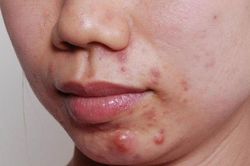 Lời khuyên từ chuyên gia: Không còn lo mụn, thâm, sẹo mùa hanh khô