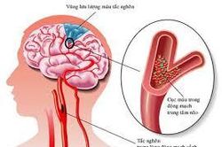 Cảnh báo gia tăng các cơn đột quỵ 'tĩnh mạch não' hiếm gặp